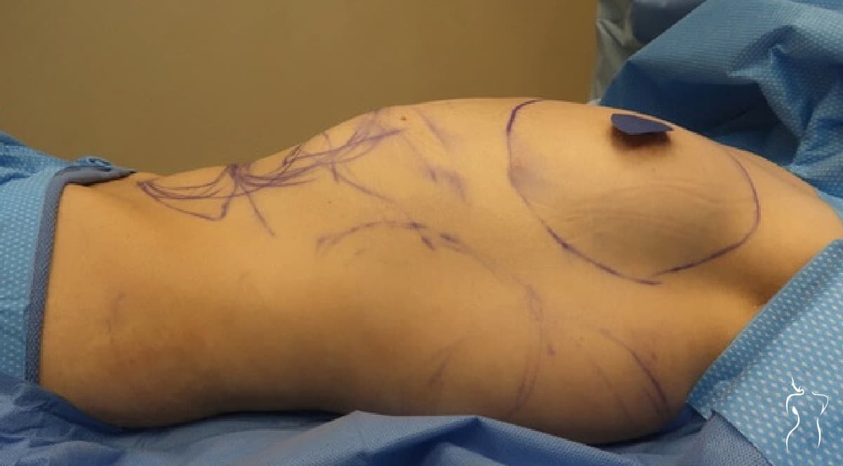 Liposuction, before — actual patient of Dr. Day