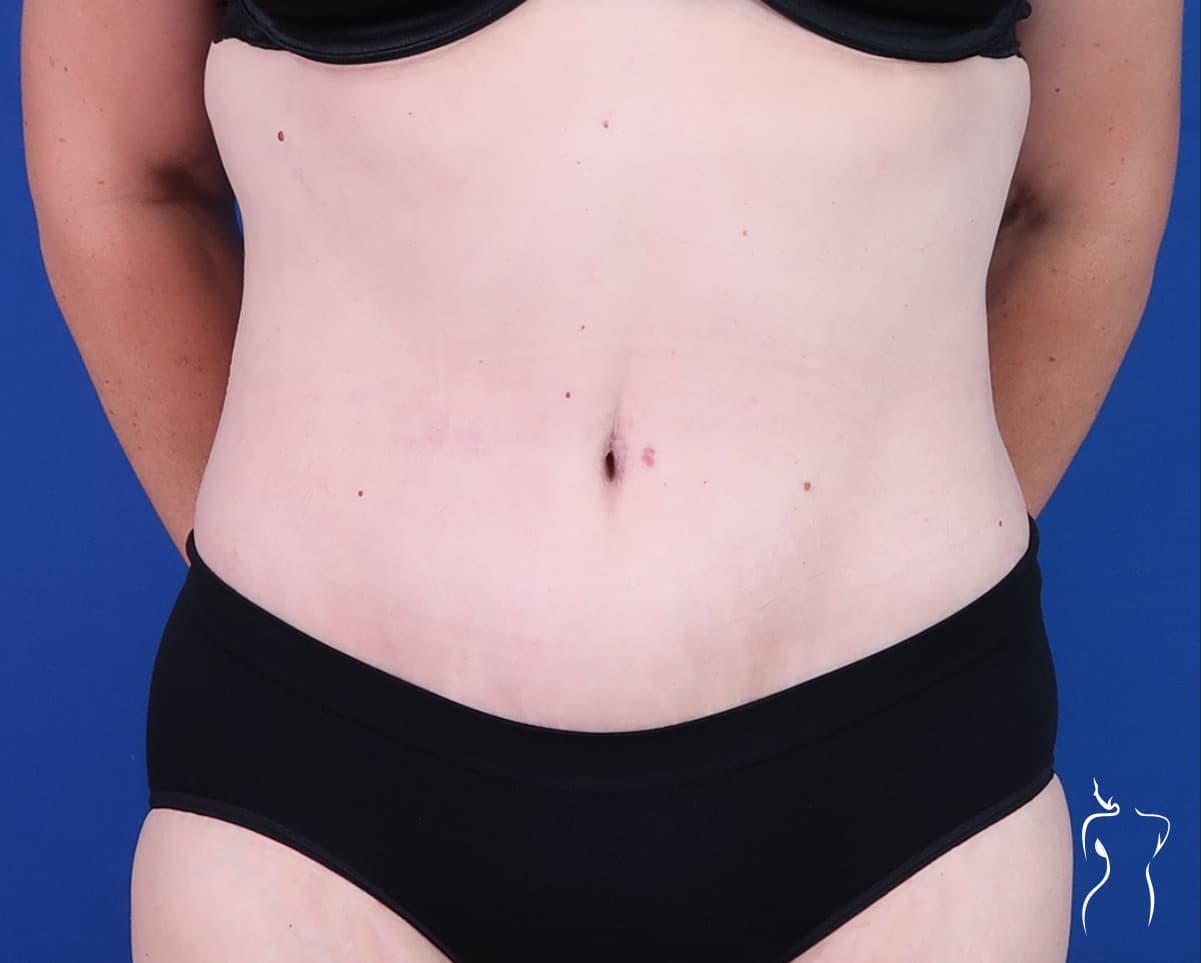 Abdominoplasty, after — actual patient of Dr. Day
