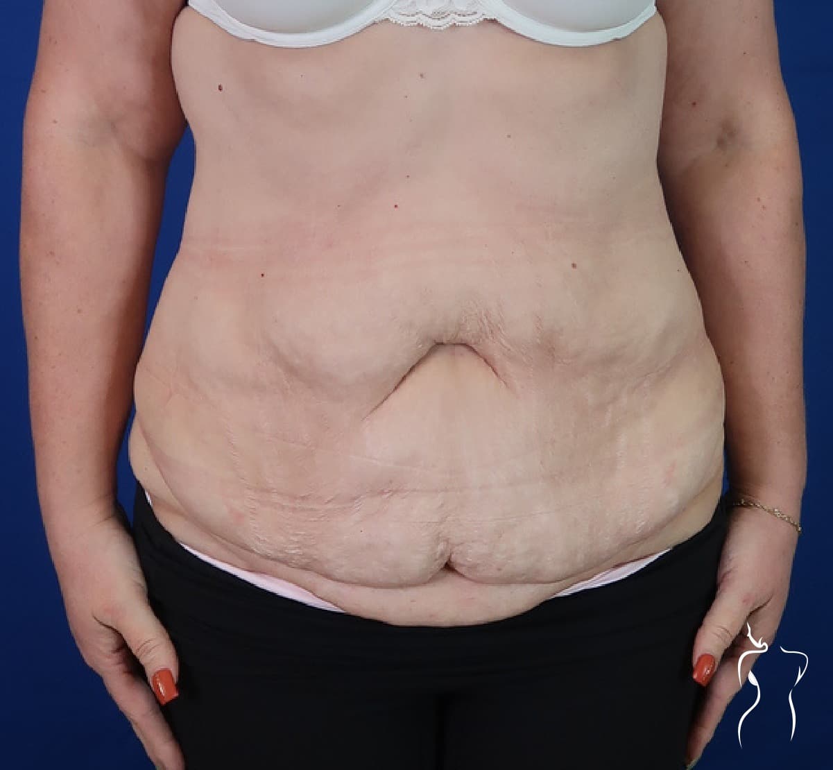 Abdominoplasty, before — actual patient of Dr. Day