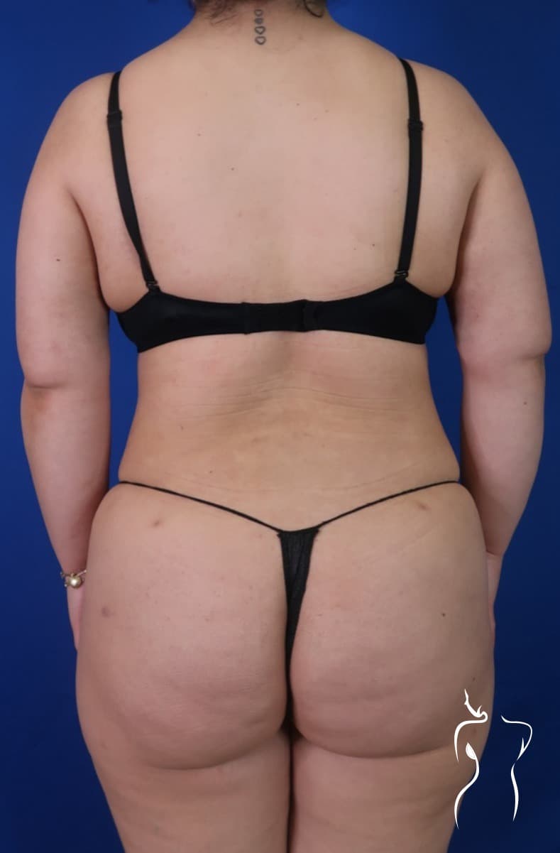 Liposuction, after — actual patient of Dr. Day