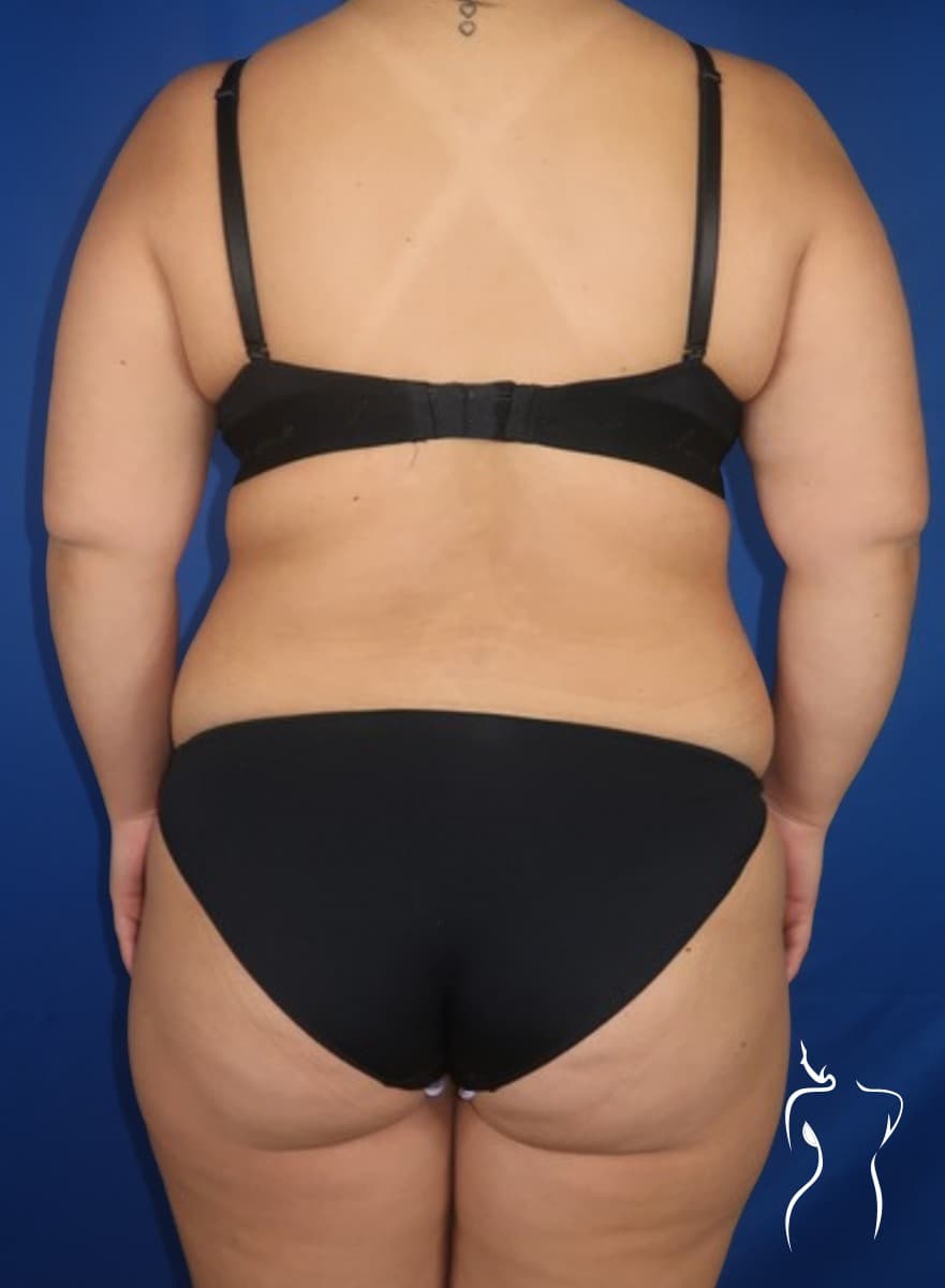 Liposuction, before — actual patient of Dr. Day