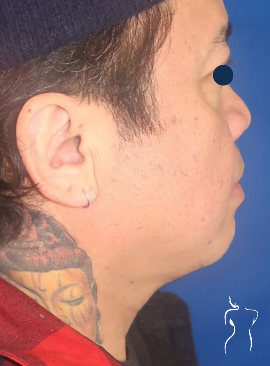 Neck Liposuction, after — actual patient of Dr. Day