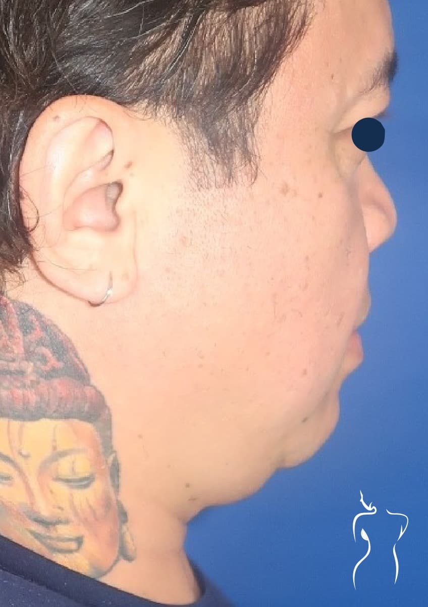 Neck Liposuction, before — actual patient of Dr. Day