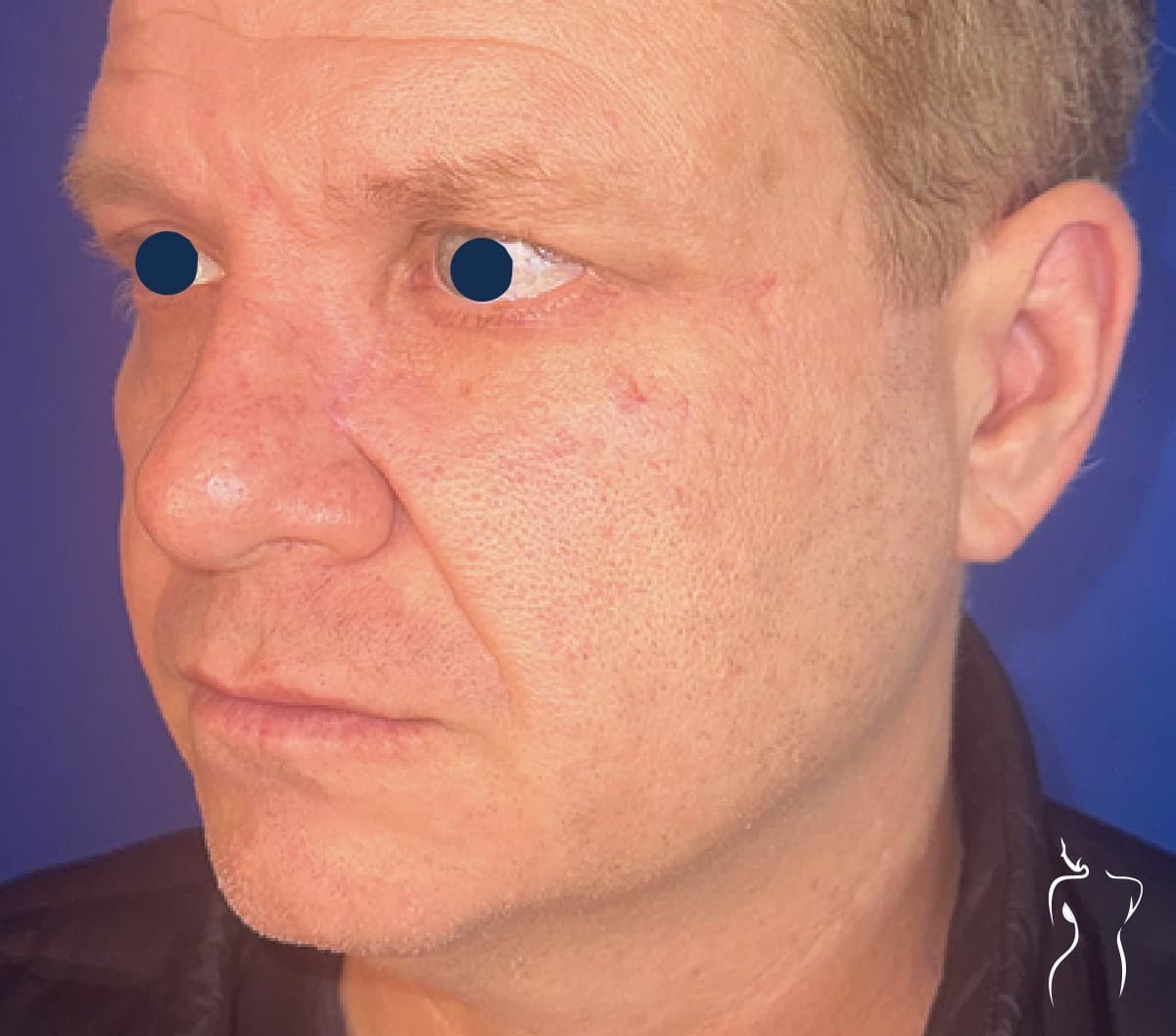 Mohs Reconstruction, after — actual patient of Dr. Day
