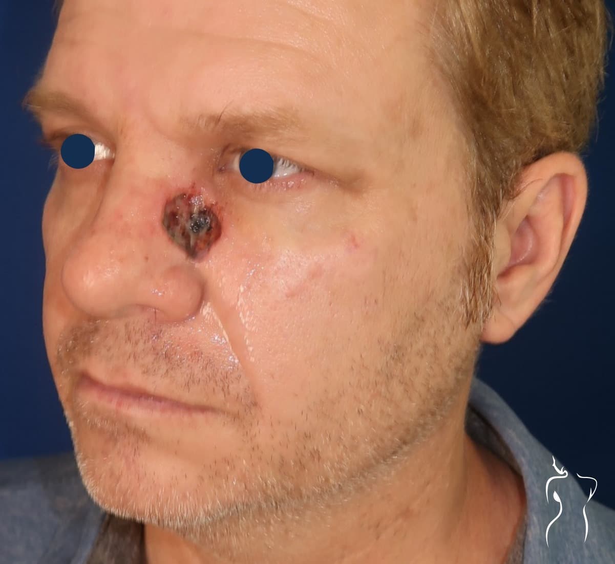 Mohs Reconstruction, before — actual patient of Dr. Day