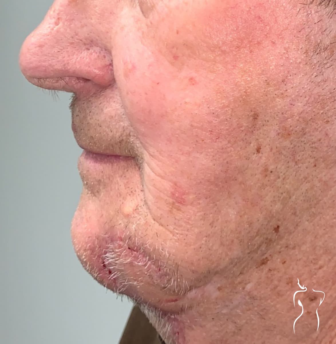 Mohs Reconstruction, after — actual patient of Dr. Day