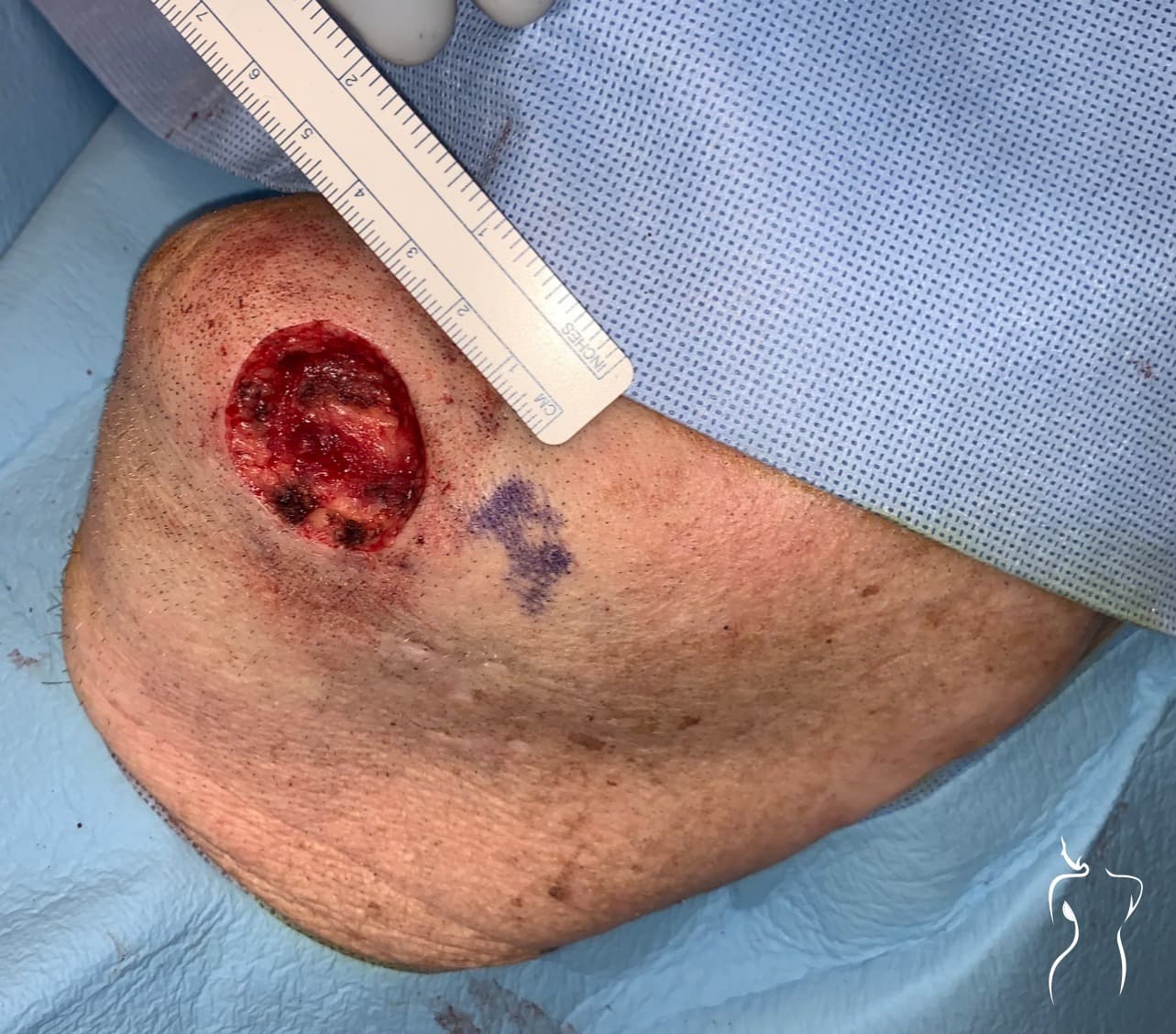 Mohs Reconstruction, before — actual patient of Dr. Day