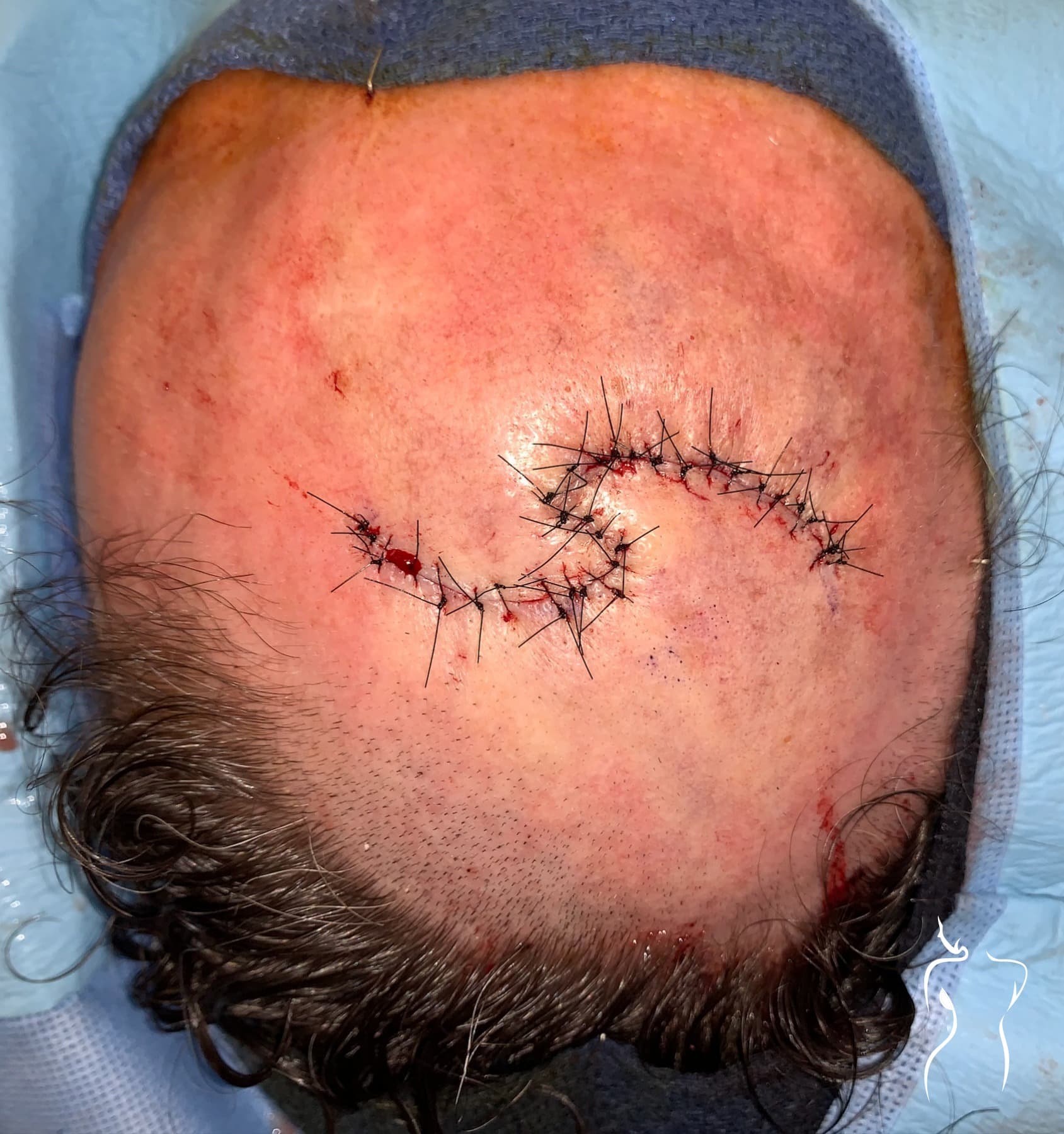 Mohs Reconstruction, after — actual patient of Dr. Day