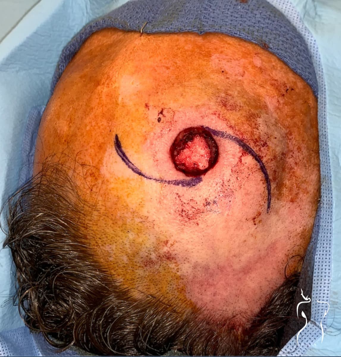 Mohs Reconstruction, before — actual patient of Dr. Day