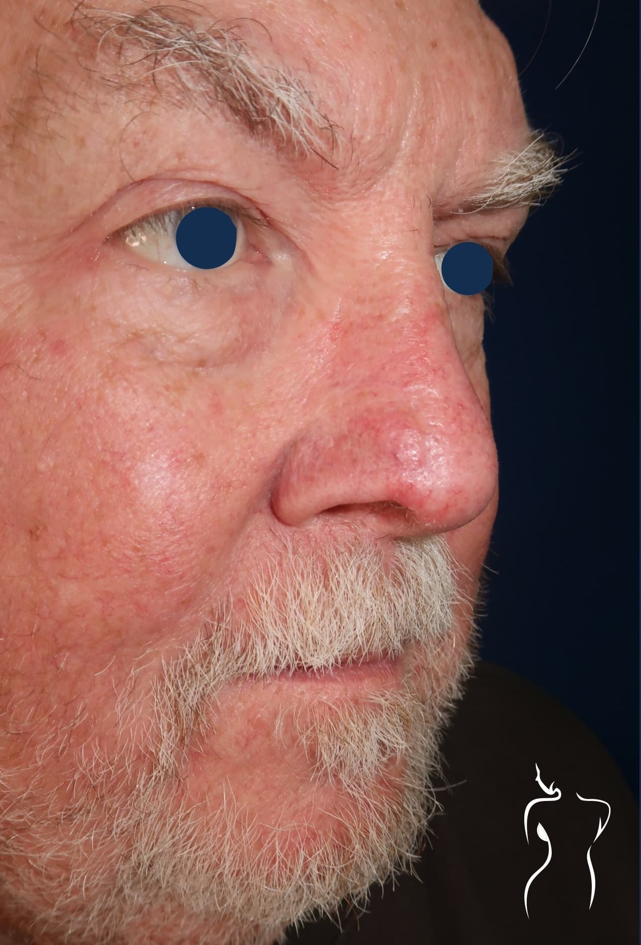 Mohs Reconstruction, after — actual patient of Dr. Day