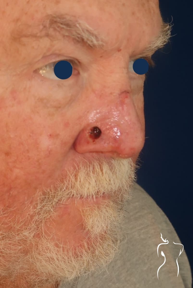 Mohs Reconstruction, before — actual patient of Dr. Day