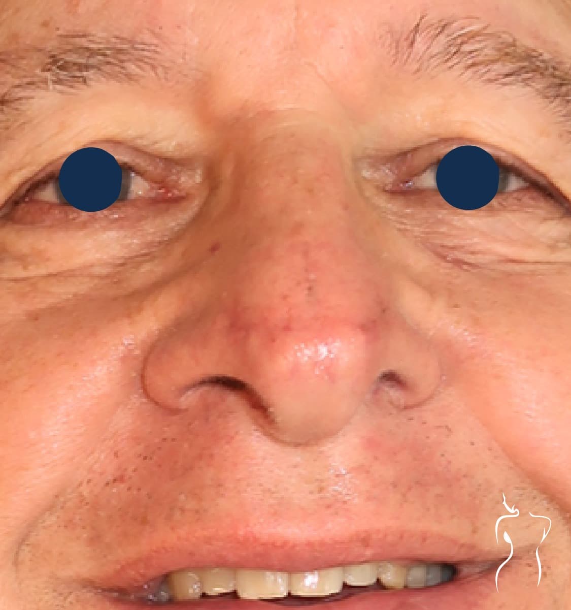 Mohs Reconstruction, after — actual patient of Dr. Day