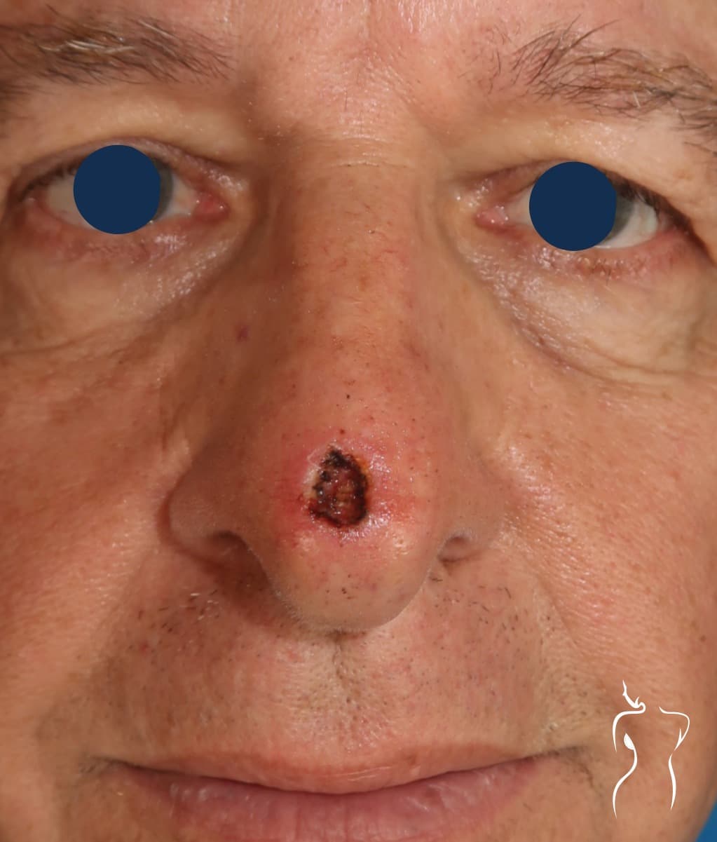Mohs Reconstruction, before — actual patient of Dr. Day