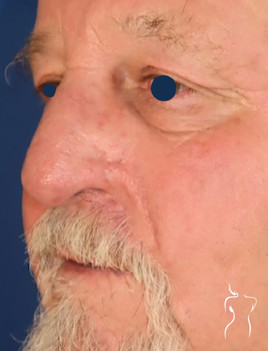 Mohs Reconstruction, after — actual patient of Dr. Day