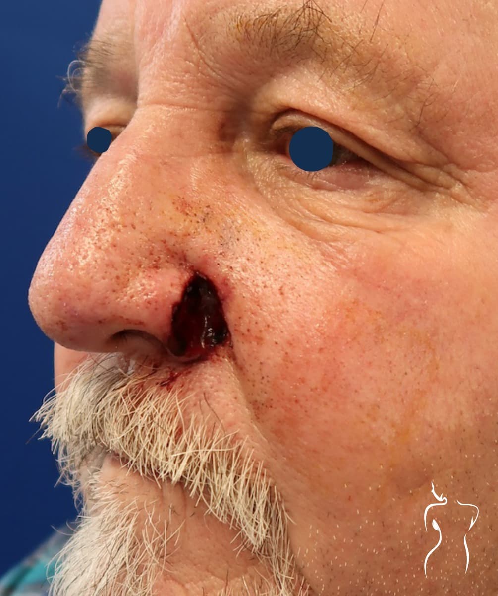 Mohs Reconstruction, before — actual patient of Dr. Day