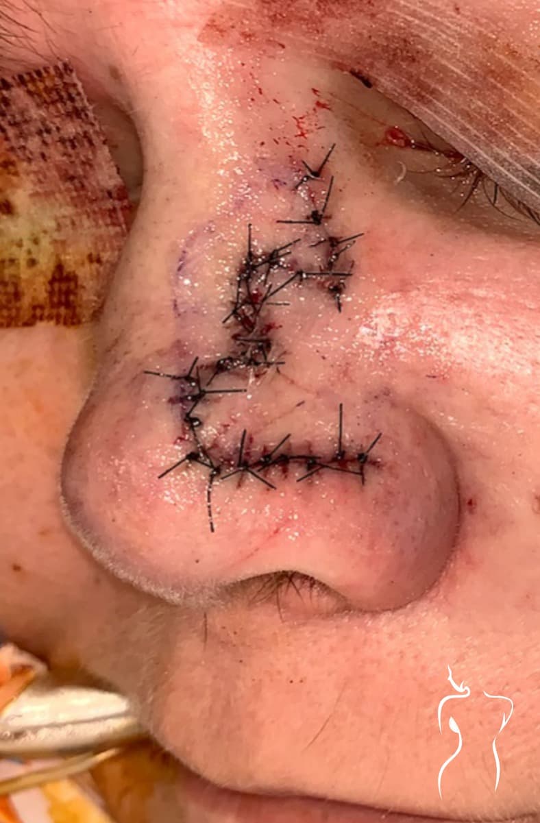 Mohs Reconstruction, after — actual patient of Dr. Day