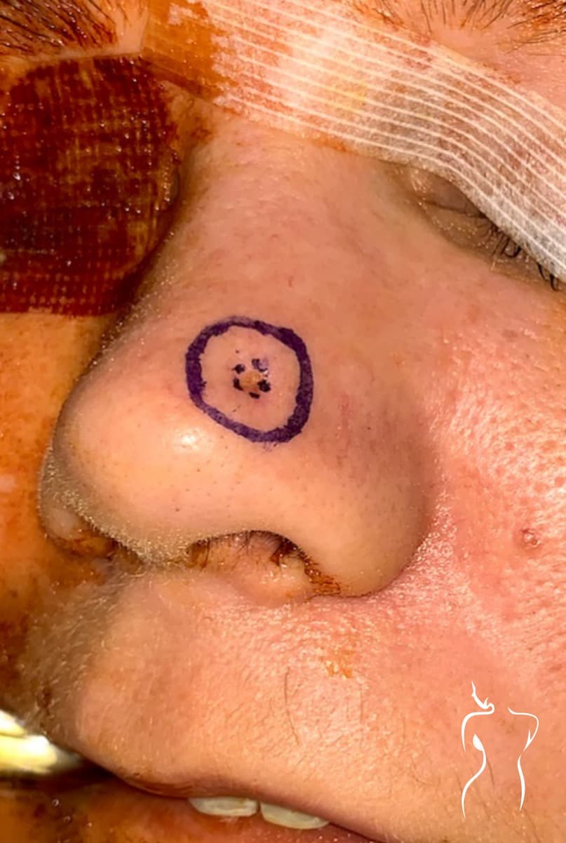 Mohs Reconstruction, before — actual patient of Dr. Day