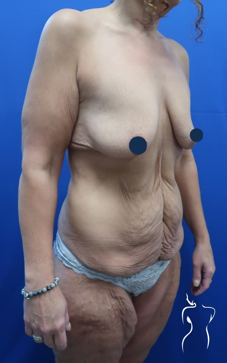 Mommy Makeover, before — actual patient of Dr. Day