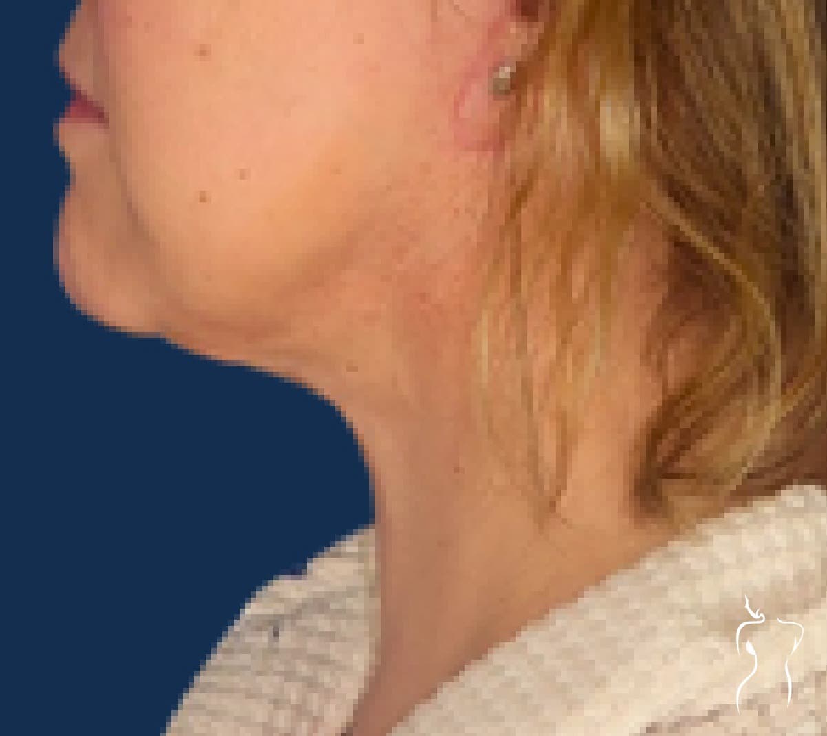 Neck Lift, after — actual patient of Dr. Day