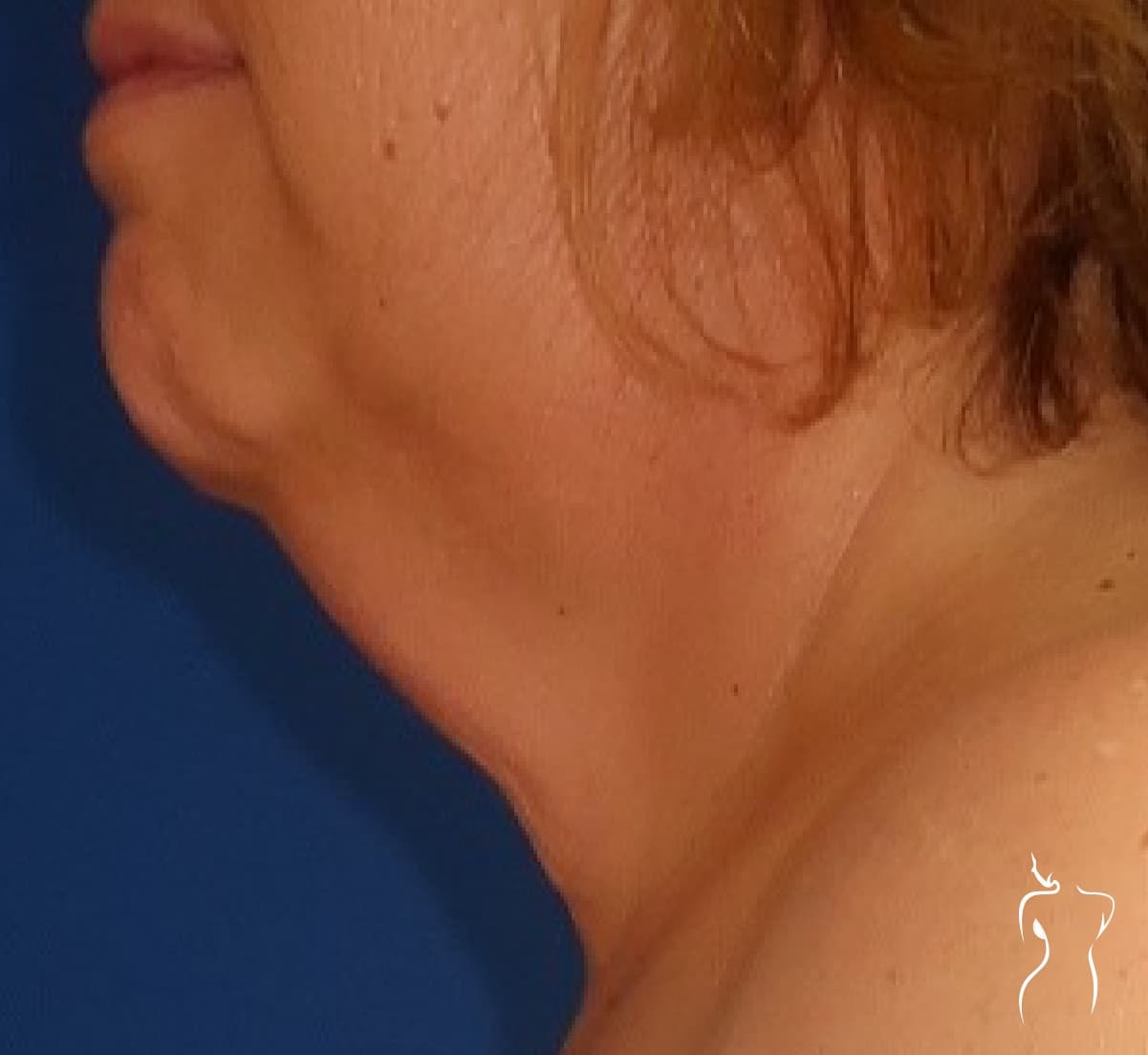 Neck Lift, before — actual patient of Dr. Day