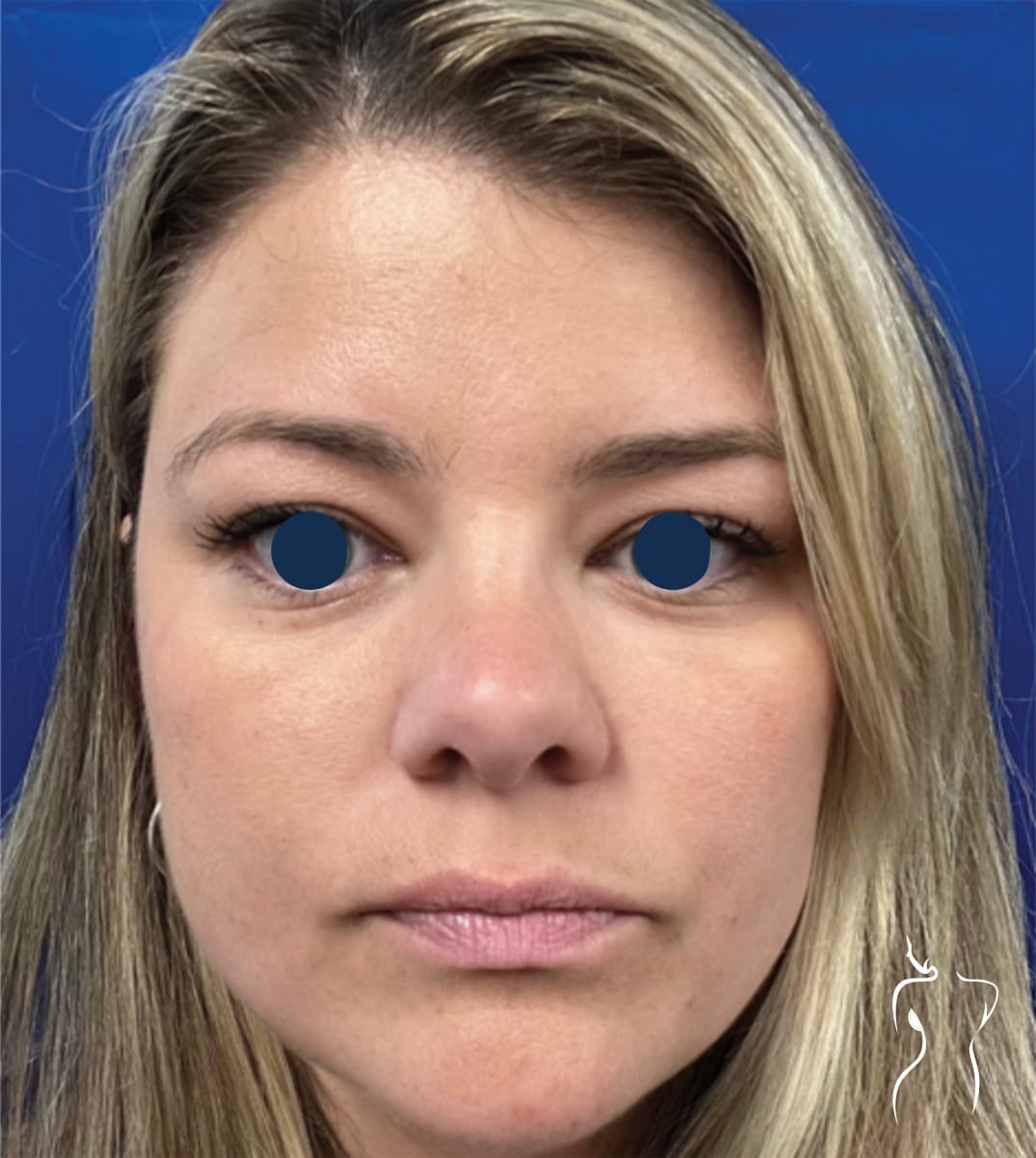 Non-Invasive Facial Rejuvenation, after — actual patient of Dr. Day