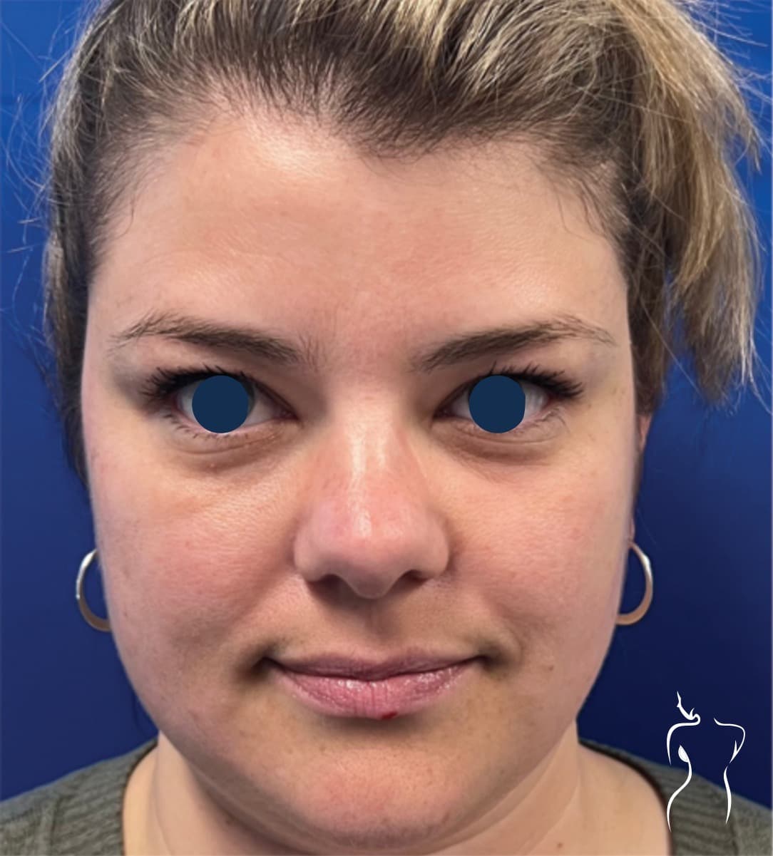 Non-Invasive Facial Rejuvenation, before — actual patient of Dr. Day