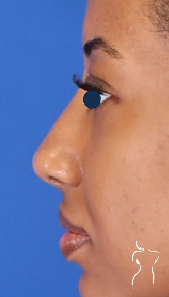 Non-Surgical Rhinoplasty, after — actual patient of Dr. Day