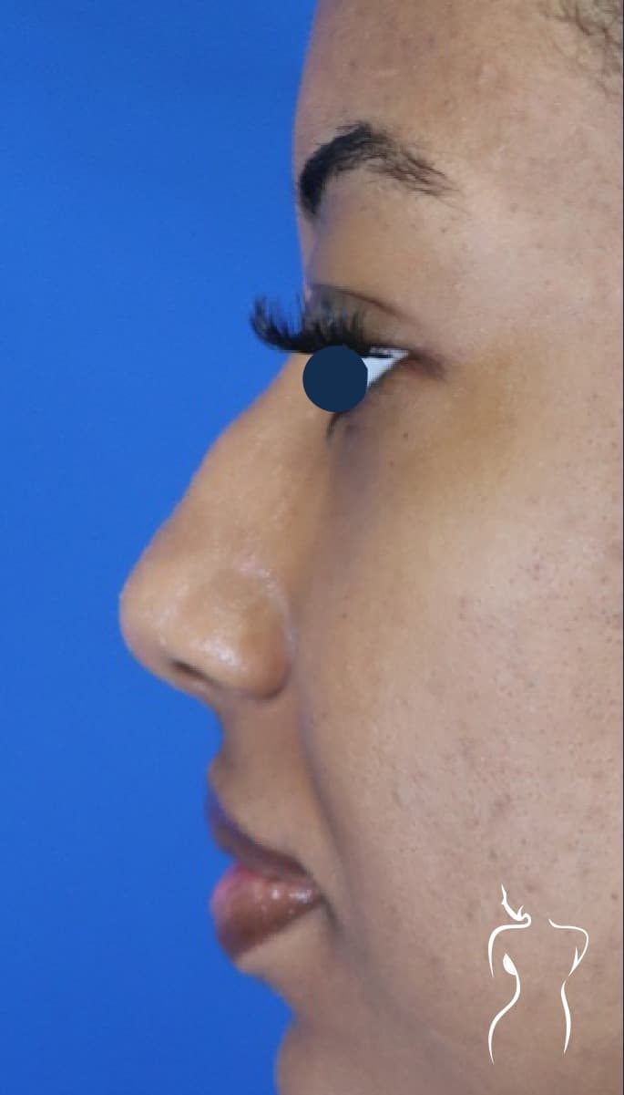 Non-Surgical Rhinoplasty, before — actual patient of Dr. Day