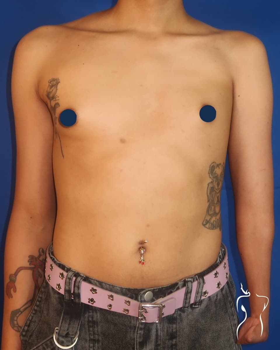 Breast Reconstruction, before — actual patient of Dr. Day