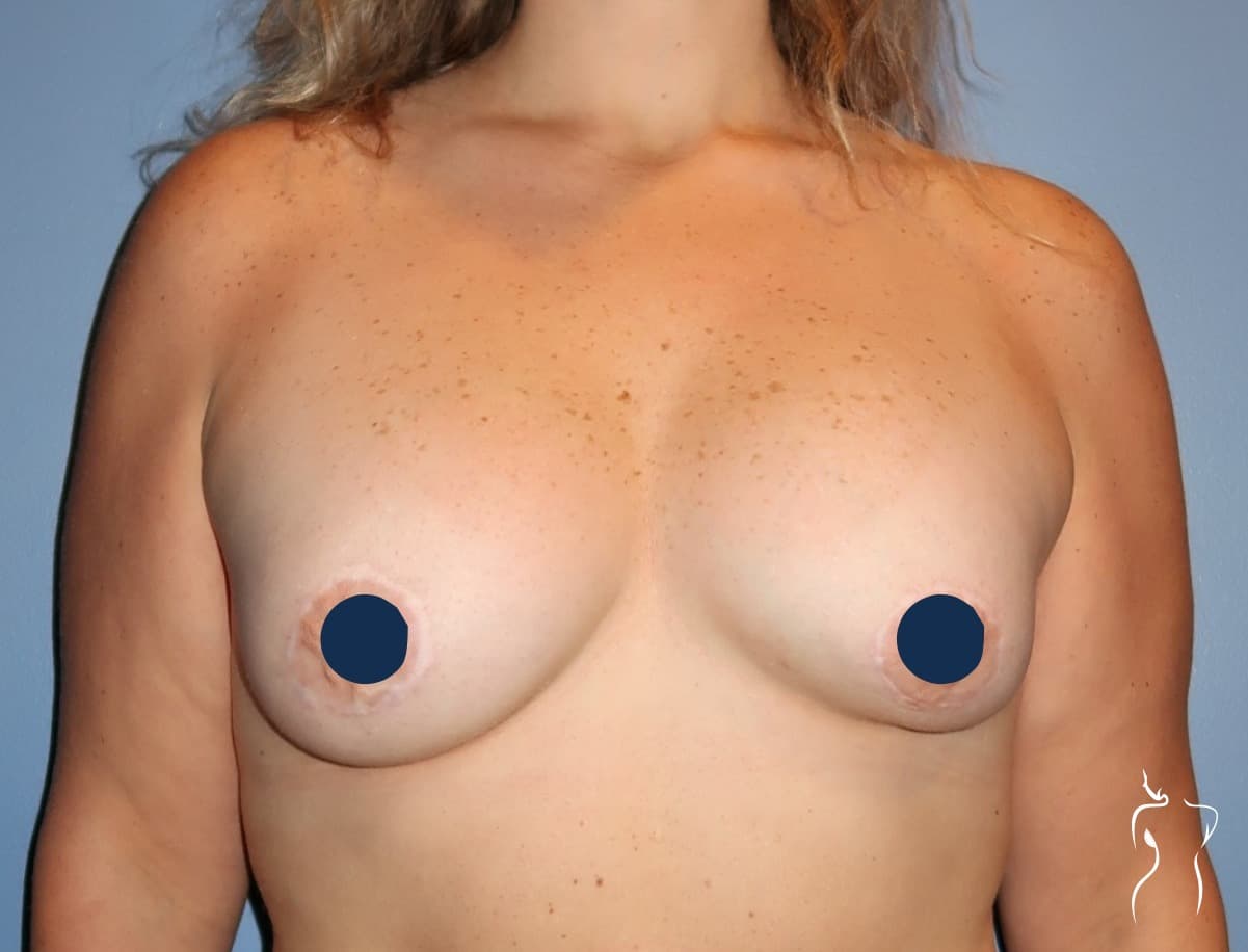 Implant Revision, before — actual patient of Dr. Day