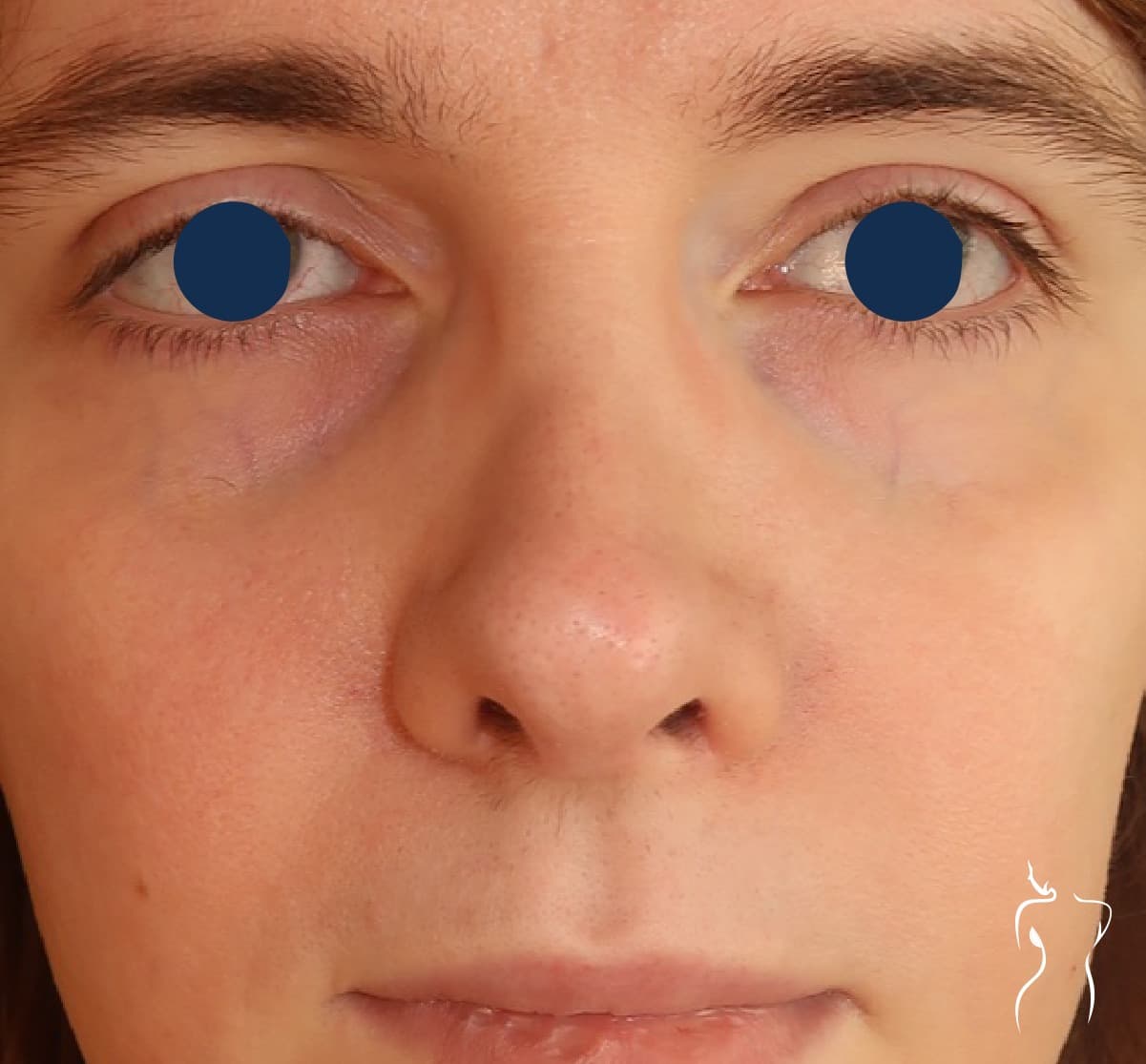 Rhinoplasty, after — actual patient of Dr. Day