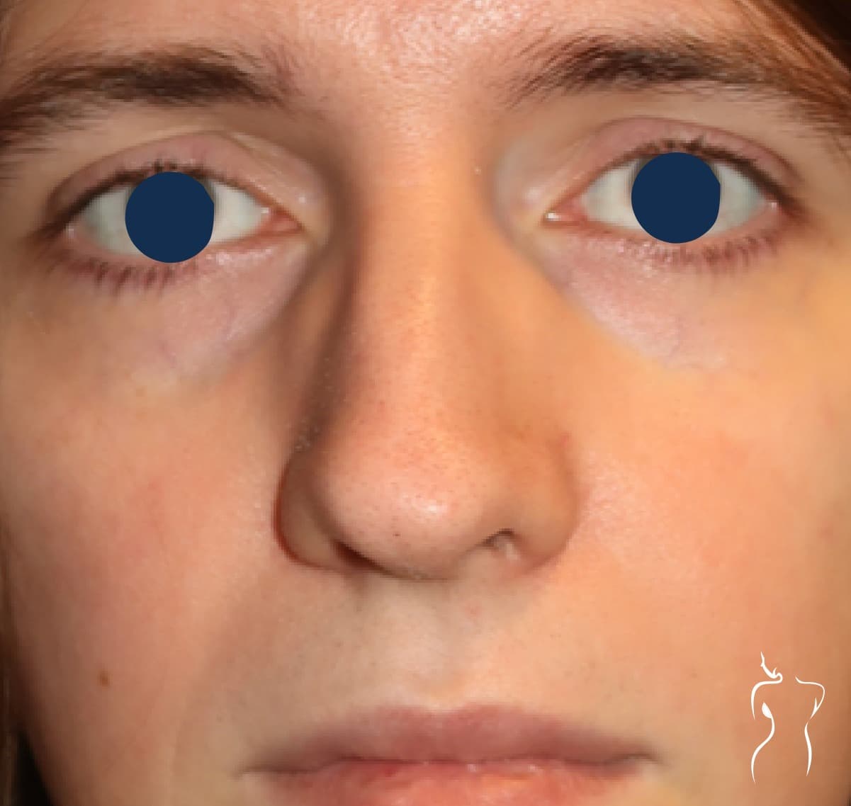 Rhinoplasty, before — actual patient of Dr. Day