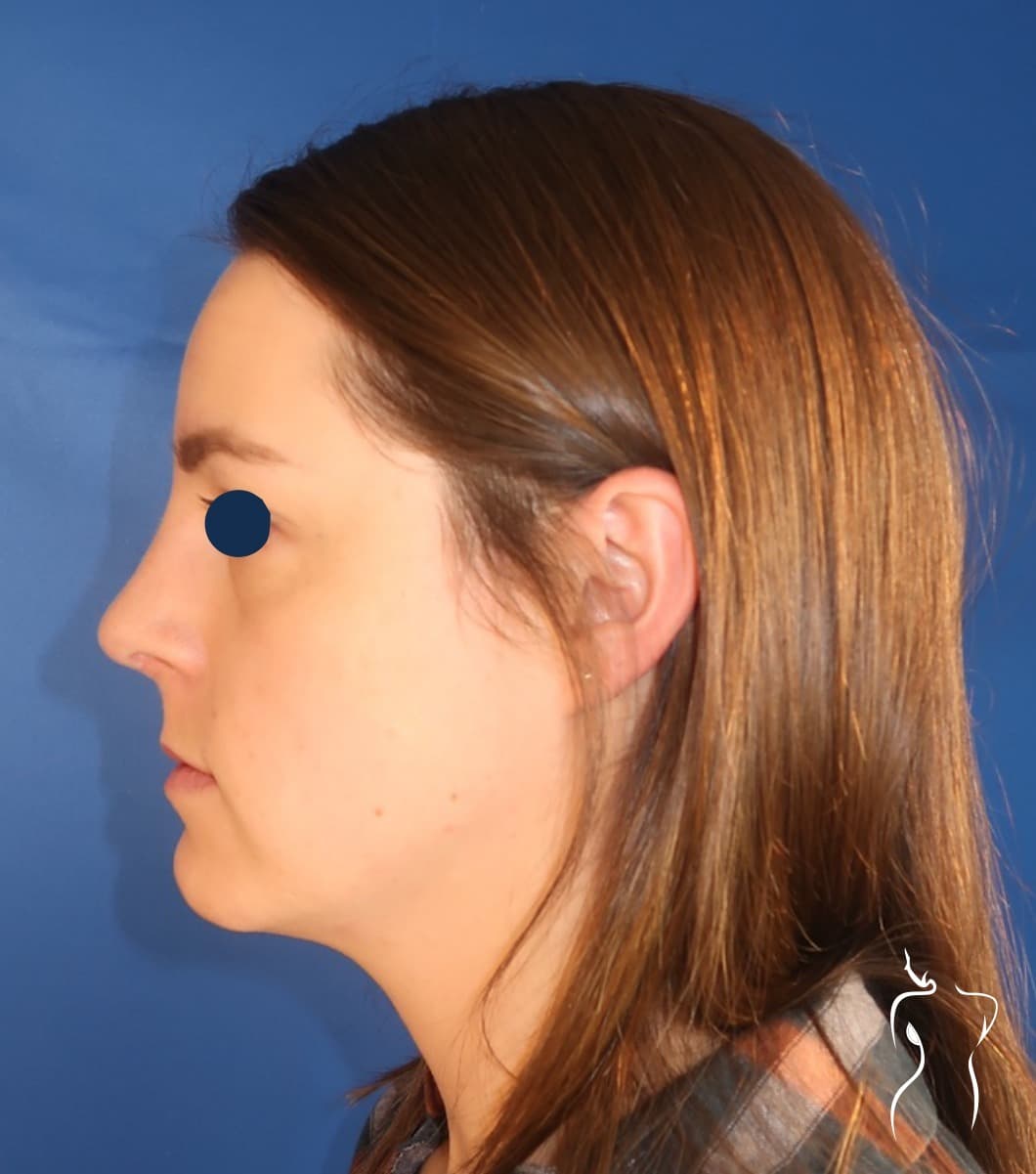 Rhinoplasty, after — actual patient of Dr. Day