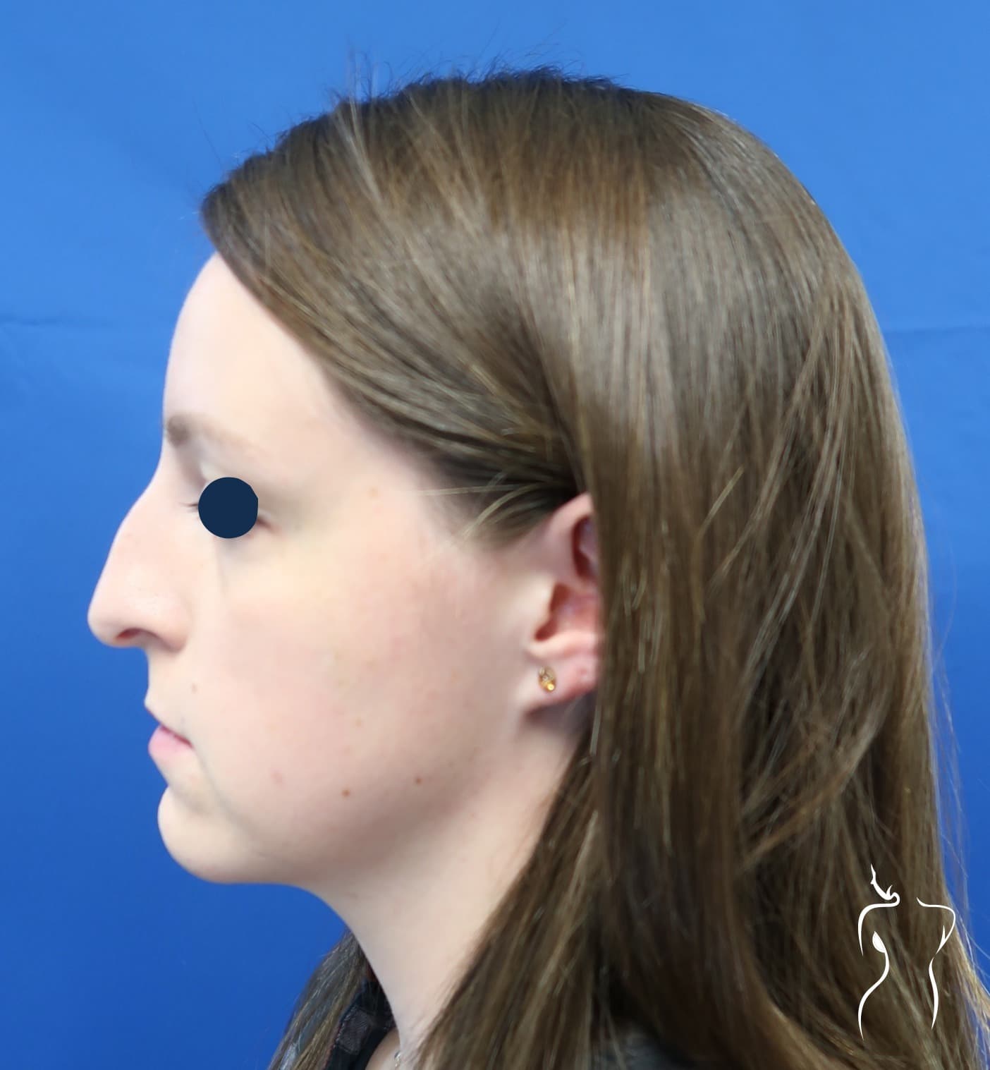 Rhinoplasty, before — actual patient of Dr. Day
