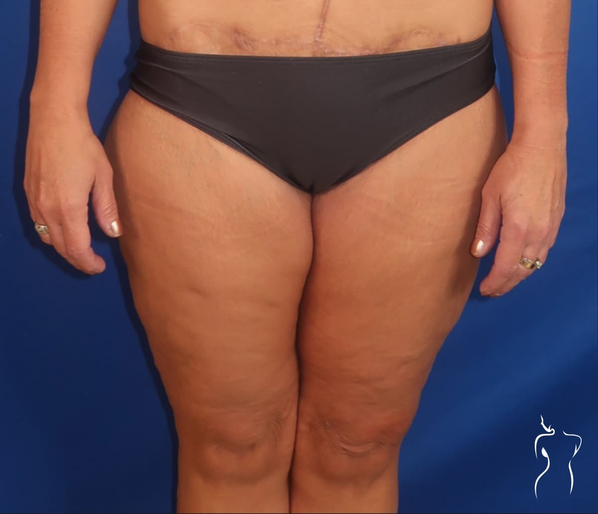 Thigh Lift, after — actual patient of Dr. Day