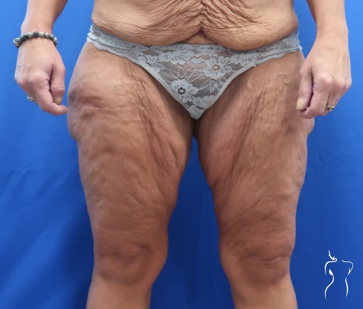 Thigh Lift, before — actual patient of Dr. Day