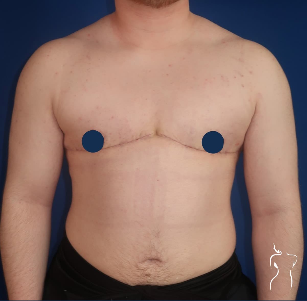Gender-Affirming Top Surgery, after — actual patient of Dr. Day