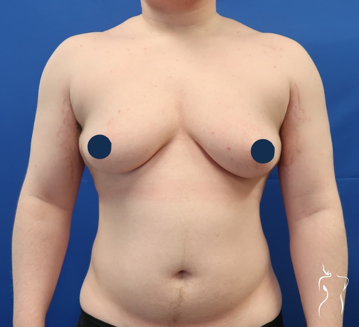 Gender-Affirming Top Surgery, before — actual patient of Dr. Day