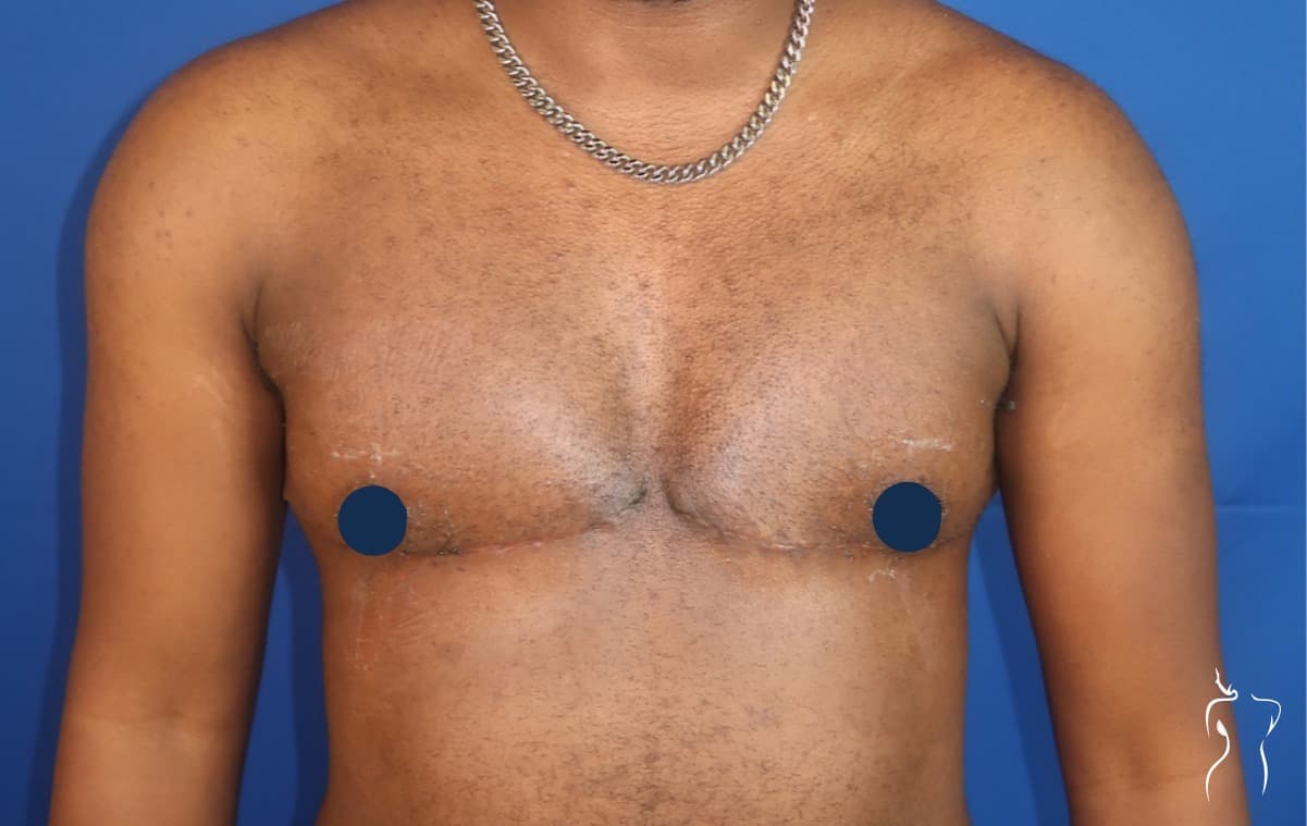 Gender-Affirming Top Surgery, after — actual patient of Dr. Day