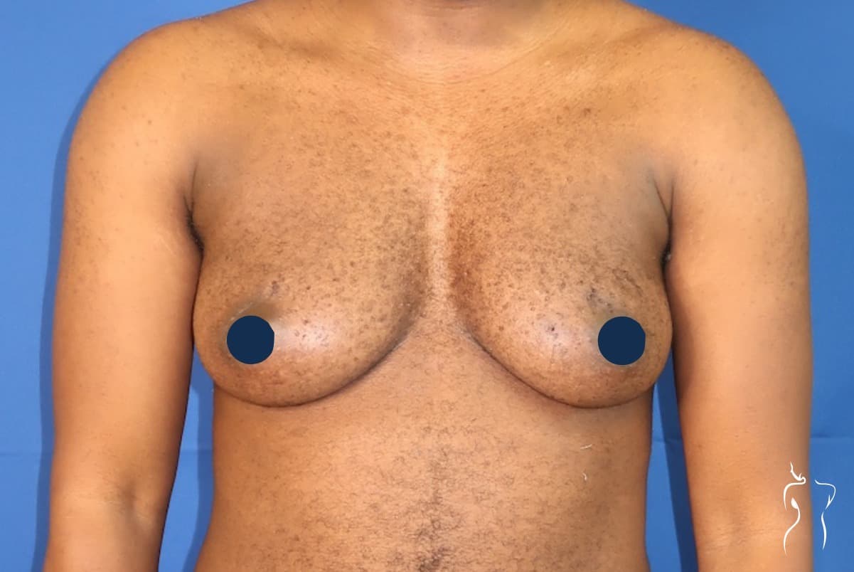 Gender-Affirming Top Surgery, before — actual patient of Dr. Day
