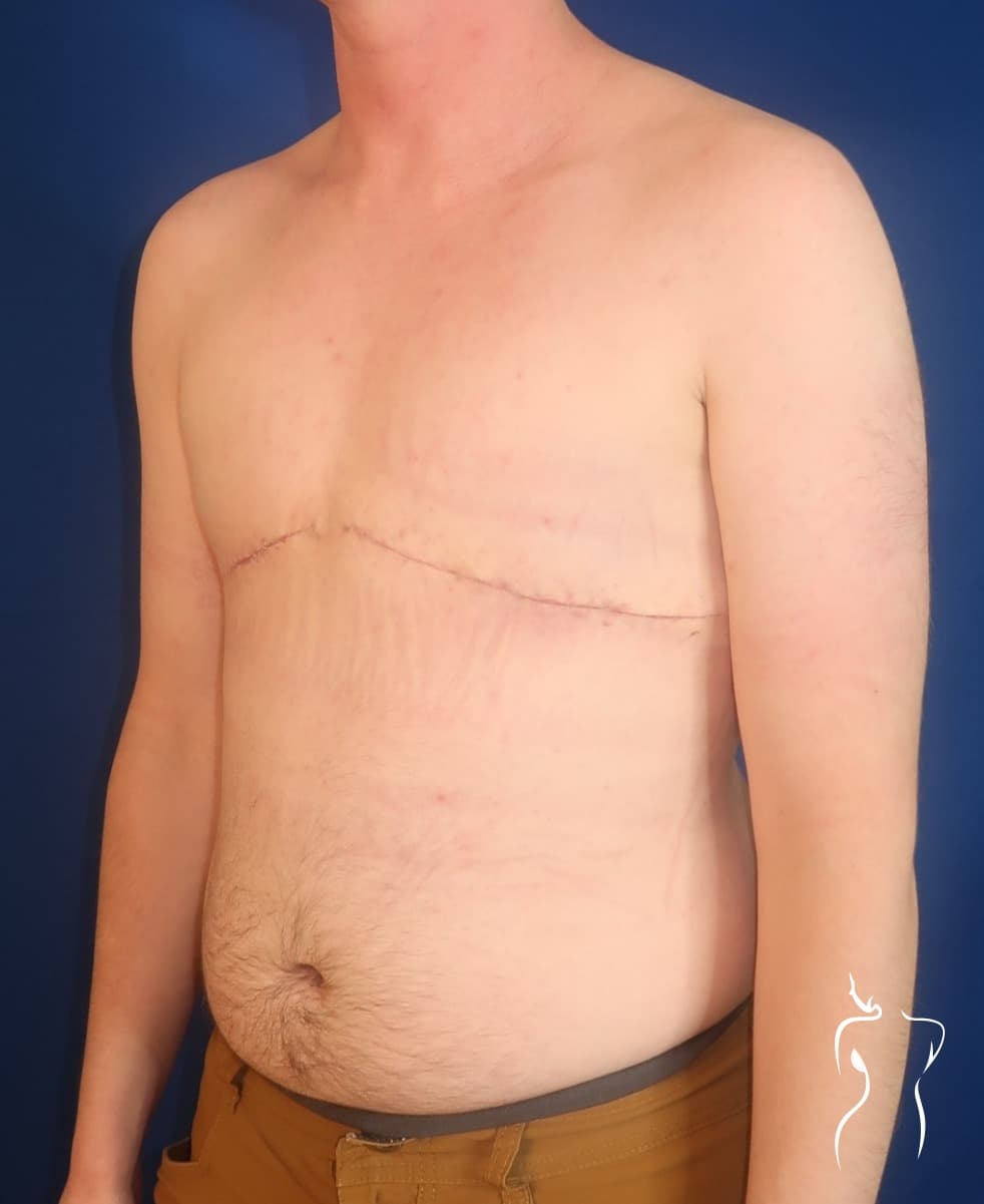 Gender-Affirming Top Surgery, after — actual patient of Dr. Day