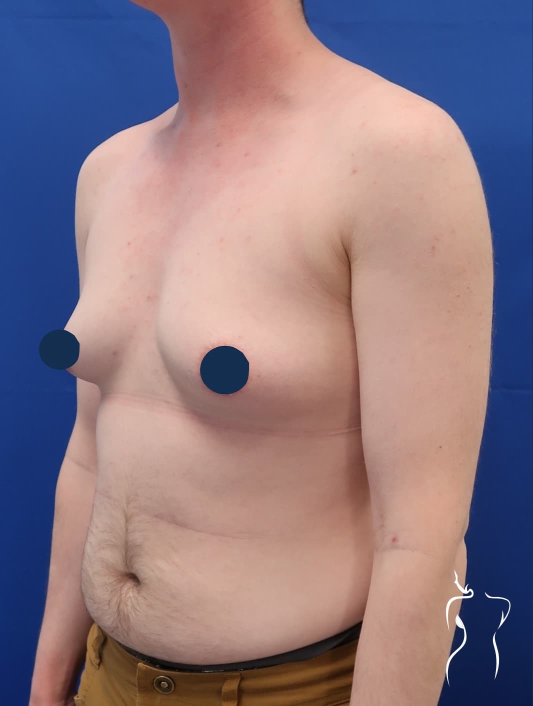 Gender-Affirming Top Surgery, before — actual patient of Dr. Day