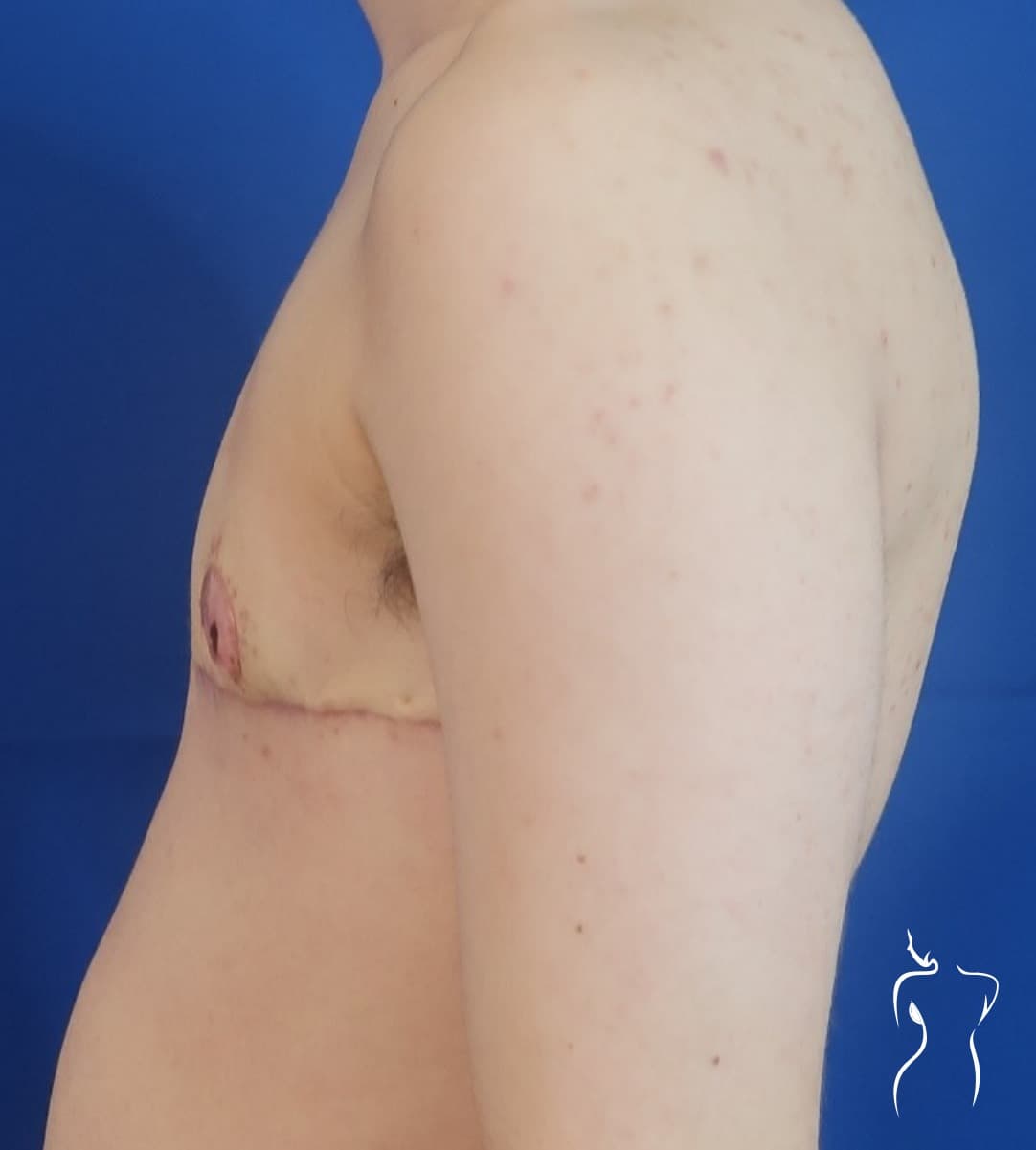 Gender-Affirming Top Surgery, after — actual patient of Dr. Day