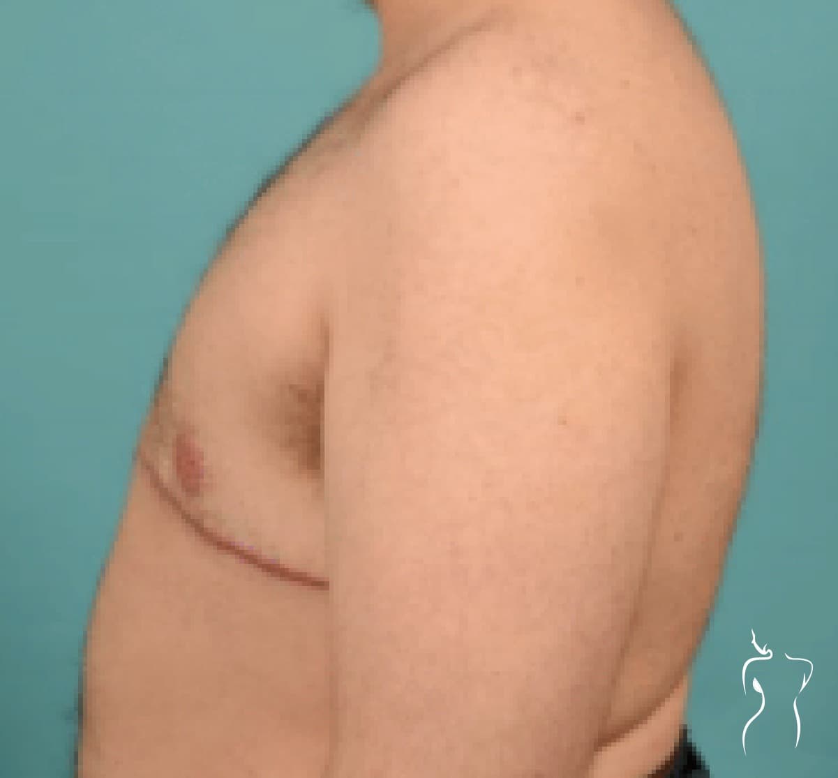 Gender-Affirming Top Surgery, after — actual patient of Dr. Day
