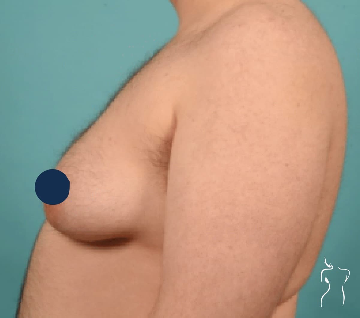 Gender-Affirming Top Surgery, before — actual patient of Dr. Day