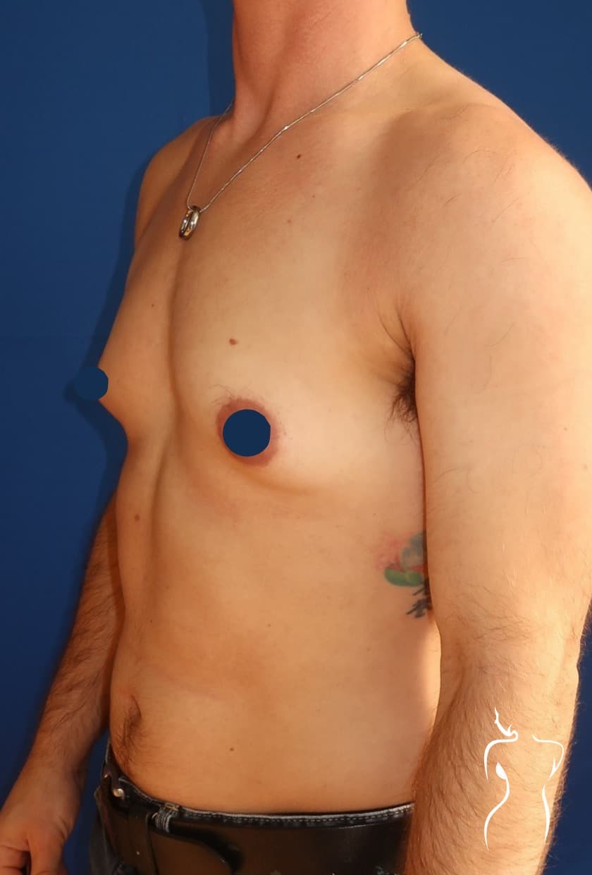 Gender-Affirming Top Surgery, before — actual patient of Dr. Day