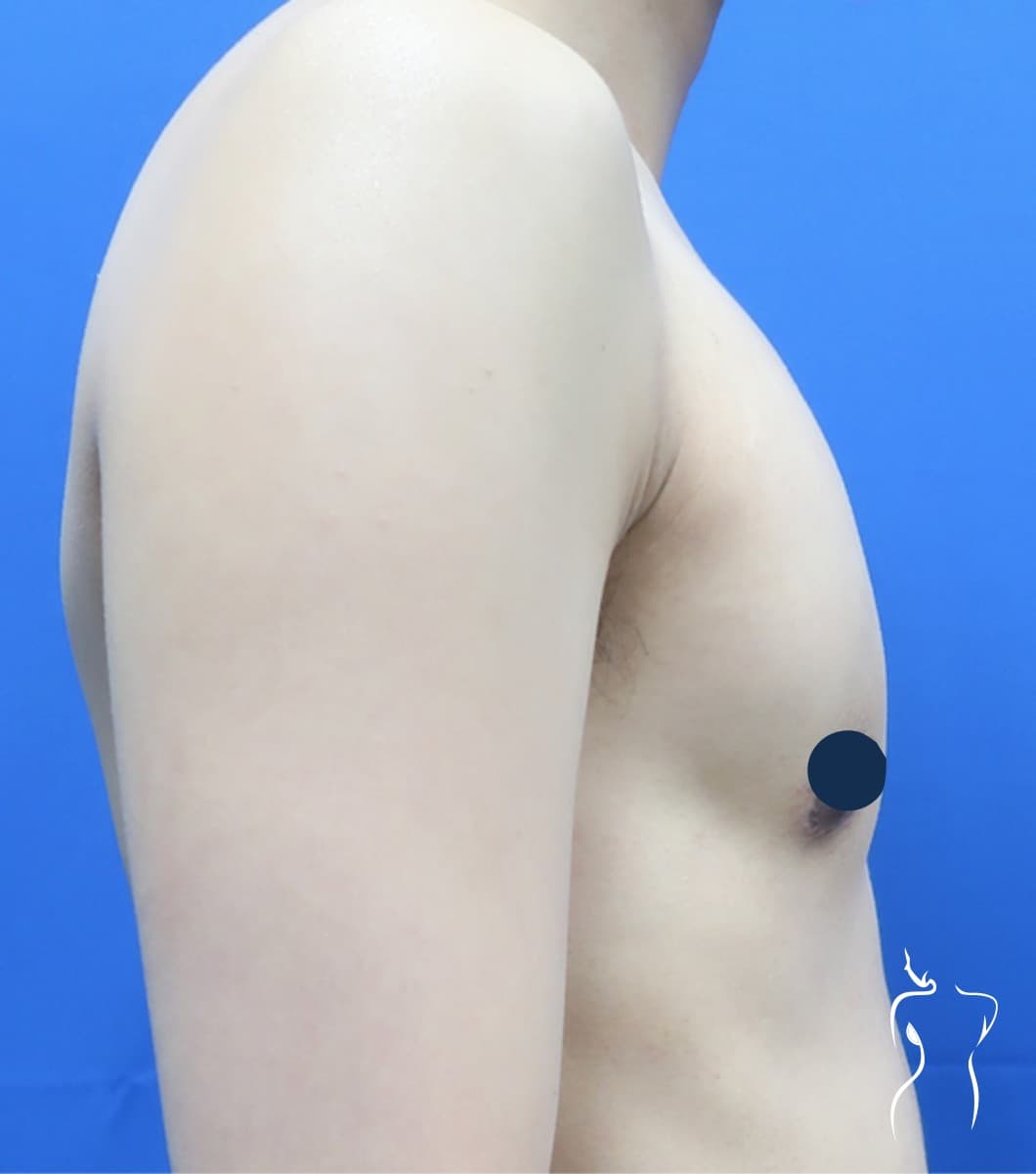 Gender-Affirming Top Surgery, after — actual patient of Dr. Day