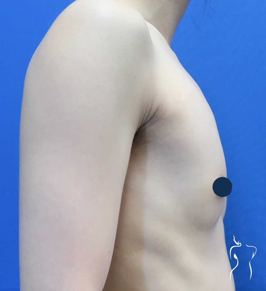 Gender-Affirming Top Surgery, before — actual patient of Dr. Day