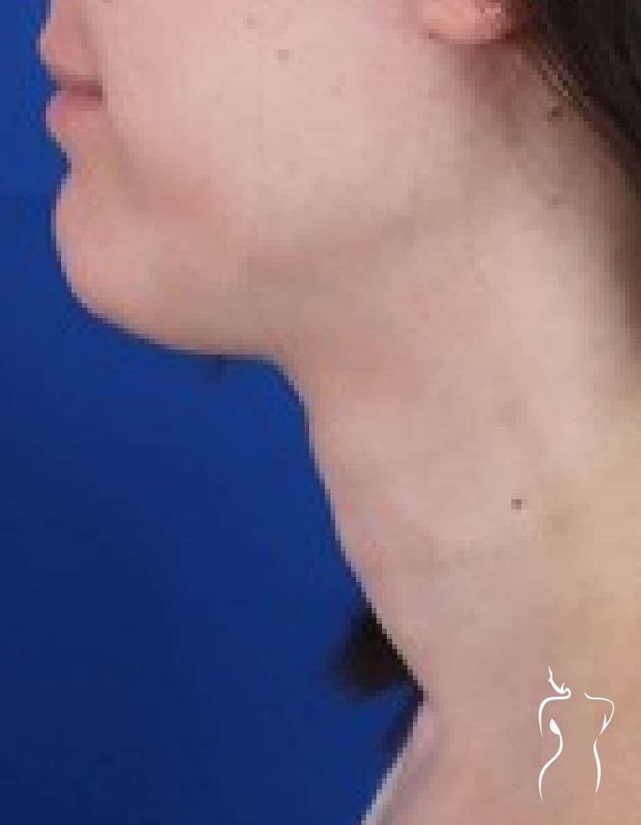 Facial Feminization, after — actual patient of Dr. Day