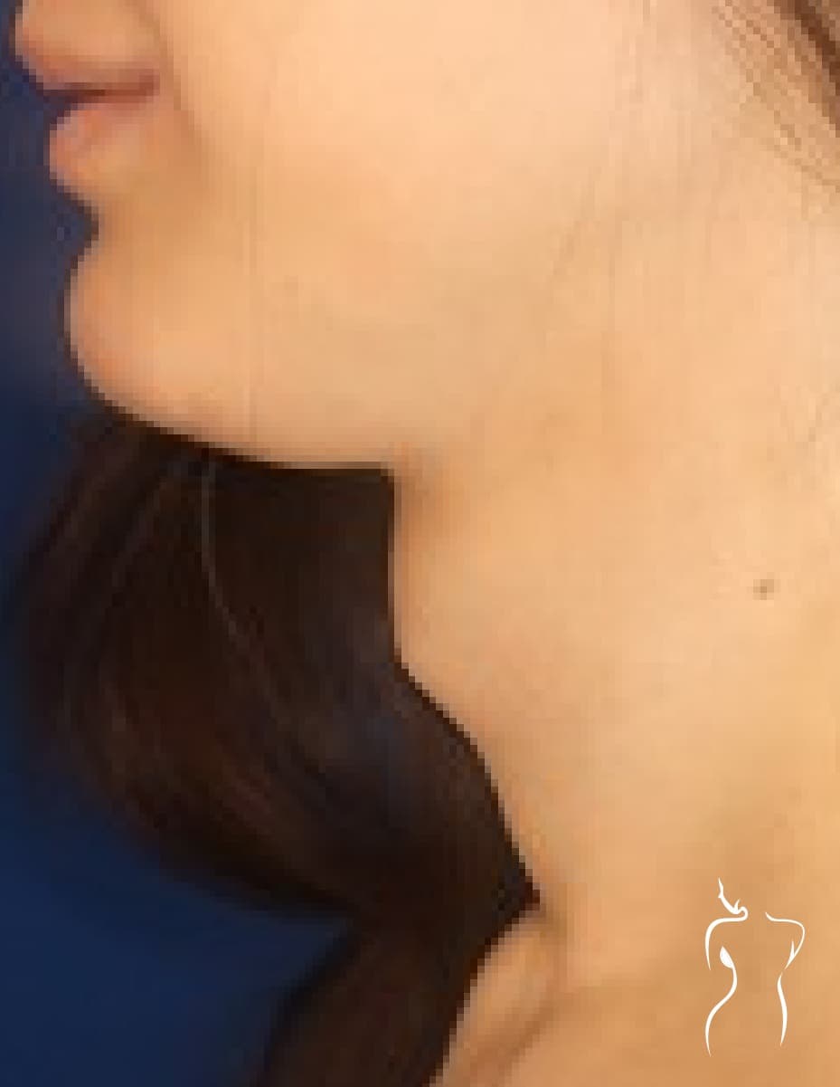 Facial Feminization, before — actual patient of Dr. Day